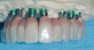Dental Implant Crowns on Model