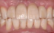 multiple dental implants
